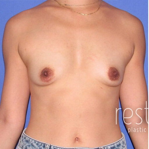 Breast Augmentation before and after - before