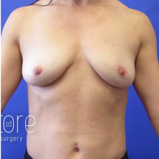Breast Augmentation before and after - after