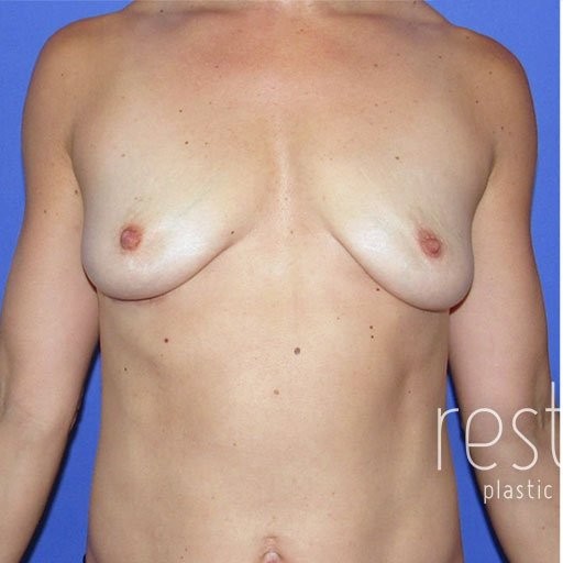Breast Augmentation before and after - before