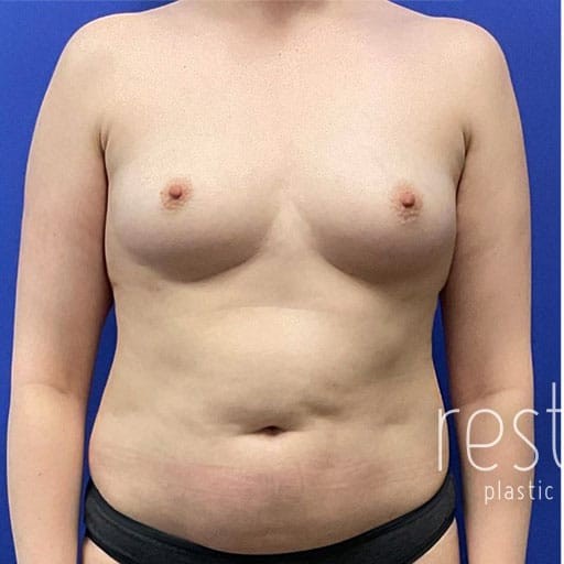 Breast Augmentation before and after - before