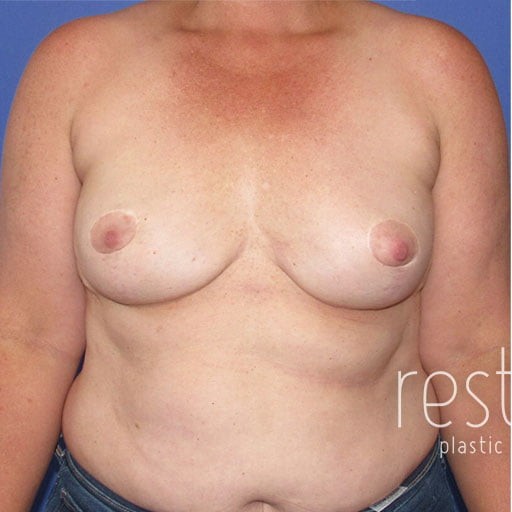Breast Augmentation before and after - before