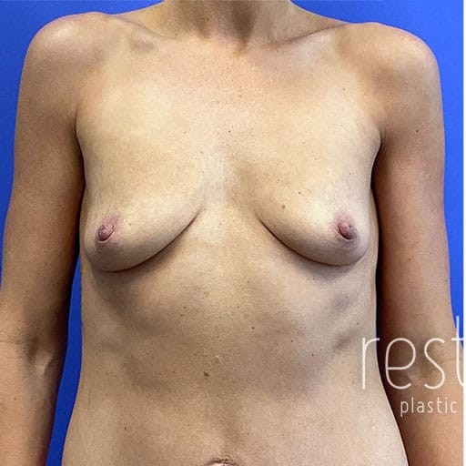 Breast Augmentation with Lift before and after - before