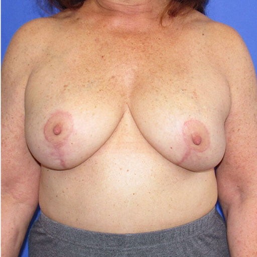 Breast Augmentation with Lift before and after - after