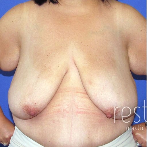 Breast Augmentation with Lift before and after - before