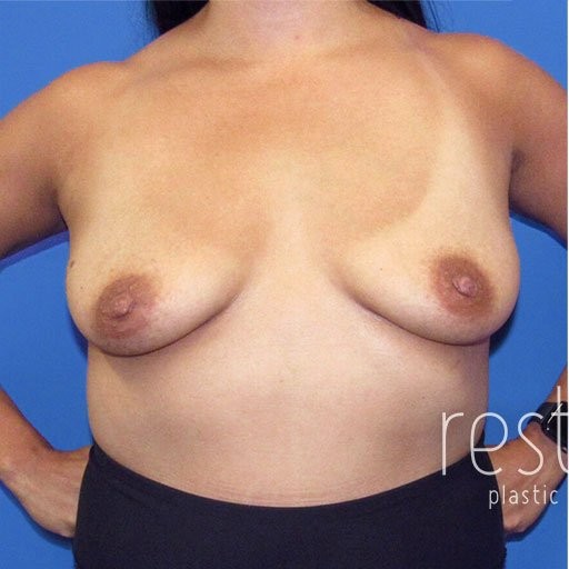 Breast Augmentation with Lift before and after - before