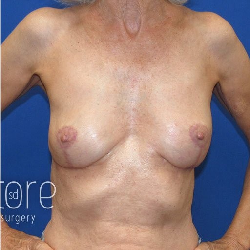 Breast Augmentation with Lift before and after - after