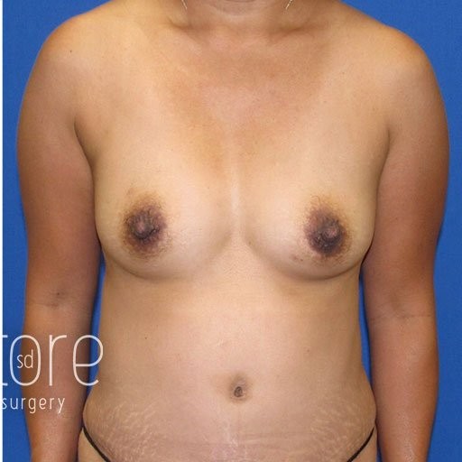 Breast Augmentation with Lift before and after - after