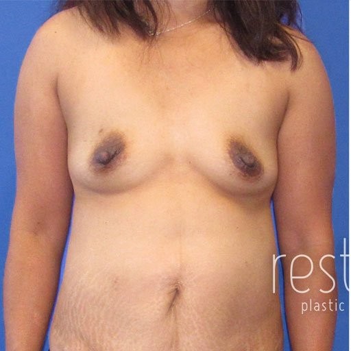 Breast Augmentation with Lift before and after - before