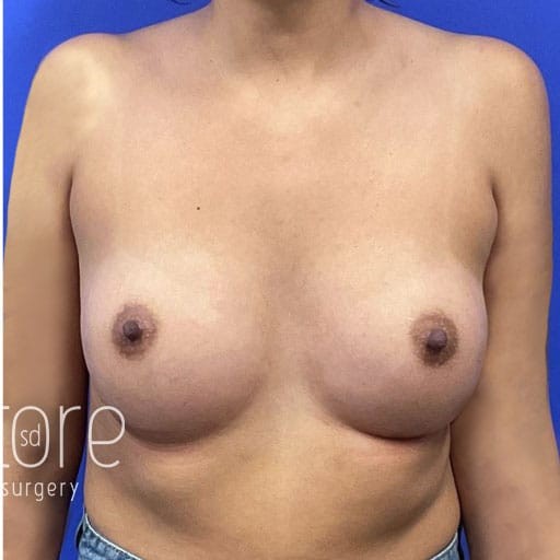 Breast Augmentation before and after - after