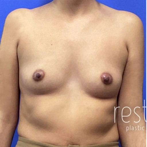Breast Augmentation before and after - before
