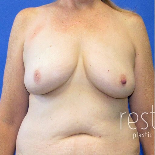Breast Augmentation with Lift before and after - before