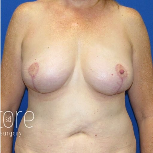 Breast Augmentation with Lift before and after - after