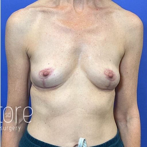 Breast Implant Removal after — Dr. Katerina Gallus