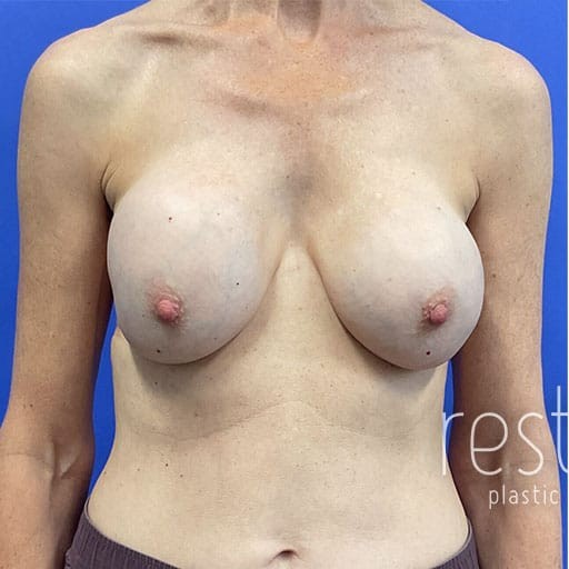 Breast Implant Removal before — Dr. Katerina Gallus