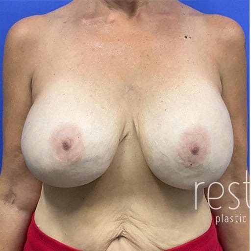 Breast Implant Removal before — Dr. Katerina Gallus