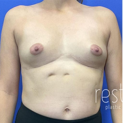 Breast Augmentation before and after - before