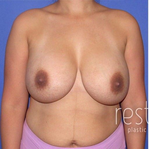 Breast Implant Removal before — Dr. Katerina Gallus