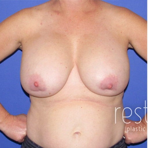 Breast Implant Removal before — Dr. Katerina Gallus