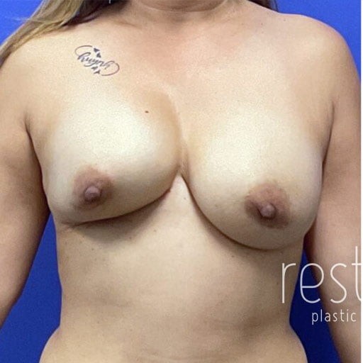 Breast Implant Revision before — Dr. Katerina Gallus
