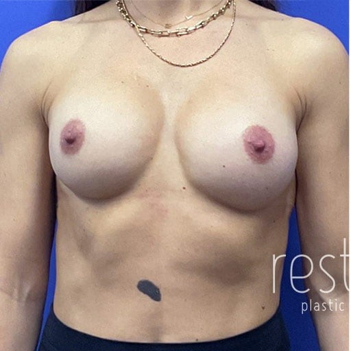 Breast Implant Revision before — Dr. Katerina Gallus
