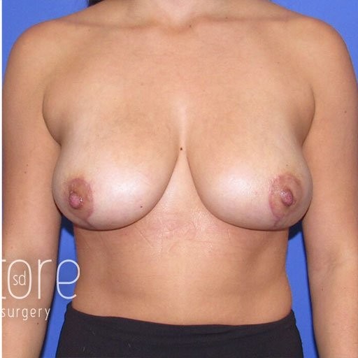 Breast Lift before and after - after