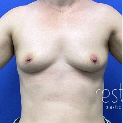 Breast Augmentation before and after - before