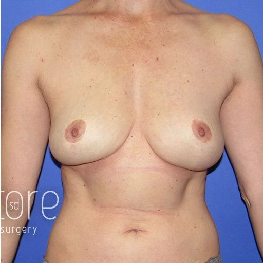 Breast Lift before and after - after