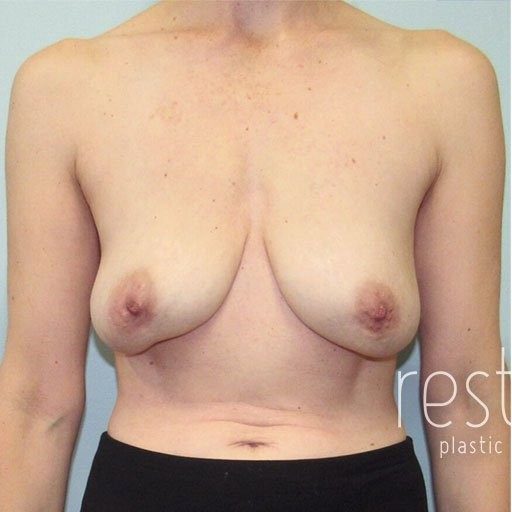 Breast Lift before and after - before