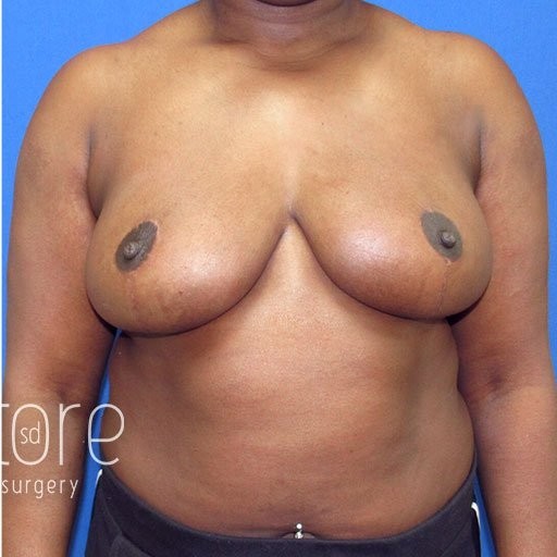 Breast Lift before and after - after
