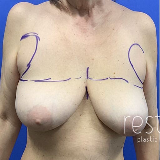 Breast Reduction before and after - before