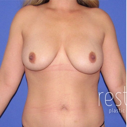 Breast Reduction before and after - before