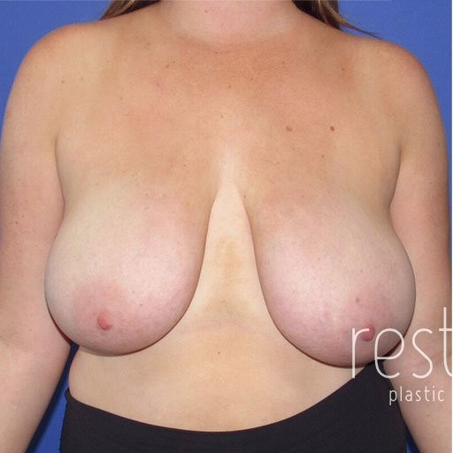 Breast Reduction before and after - before