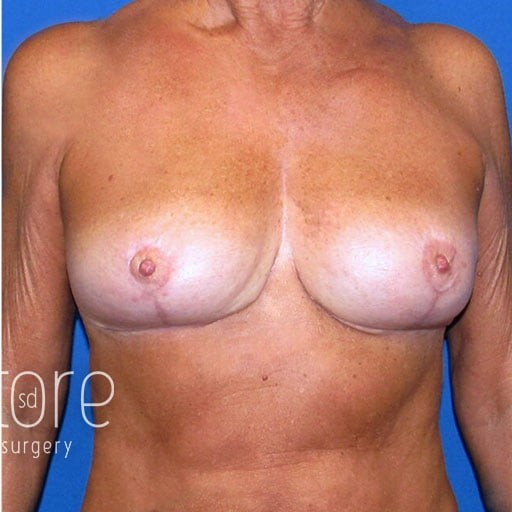 Breast Reduction before and after - after