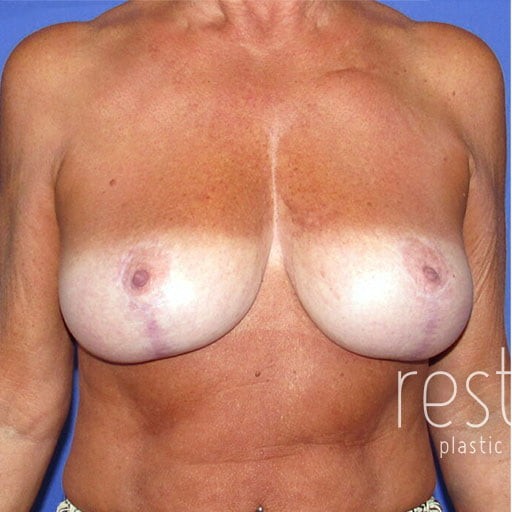 Breast Reduction before and after - before