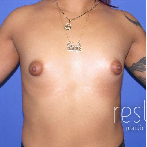 Breast Augmentation before and after - before
