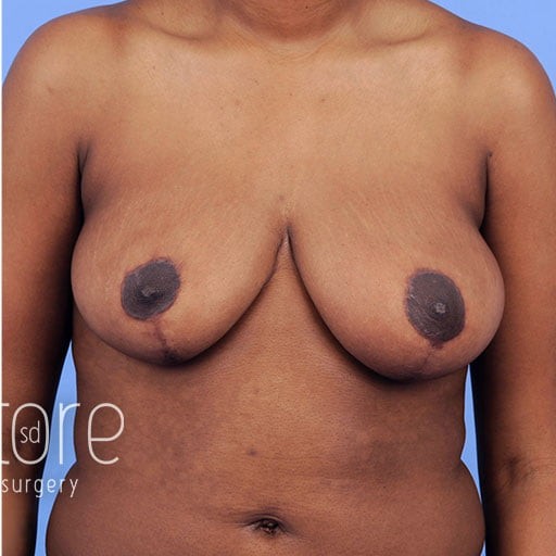 Breast Reduction before and after - after