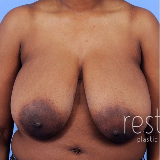 Breast Reduction before and after - before
