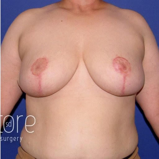 Breast Reduction before and after - after