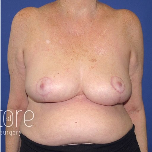 Breast Reduction before and after - after