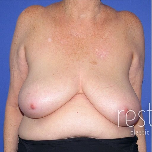 Breast Reduction before and after - before