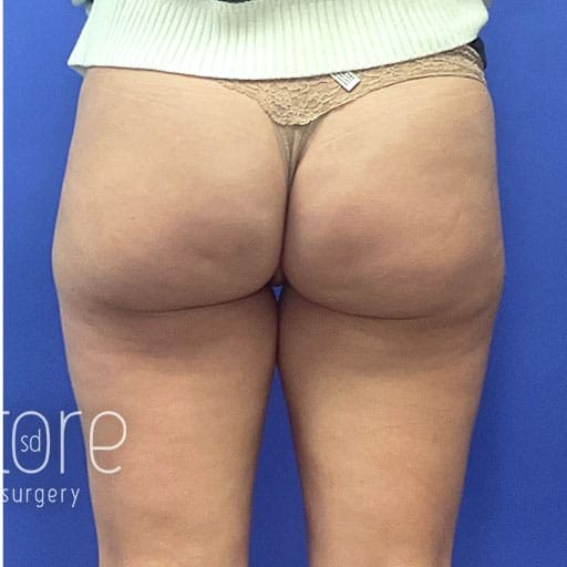 Cellulite Reduction before and after - after