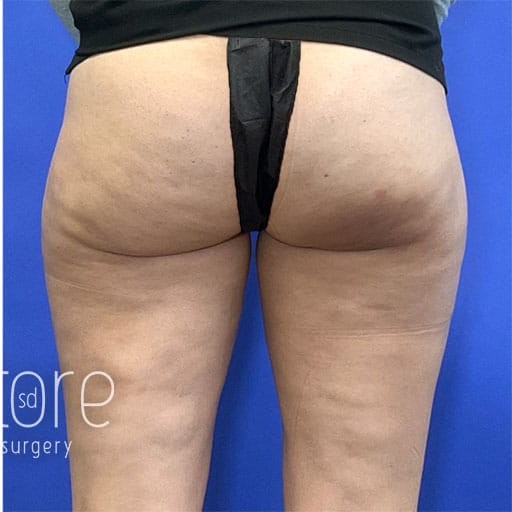 Cellulite Reduction before and after - after