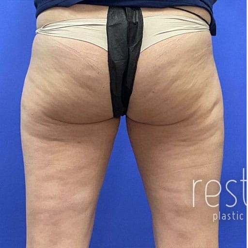 Cellulite Reduction before and after - before