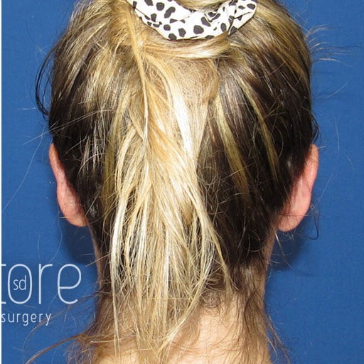 Ear Surgery before and after - after