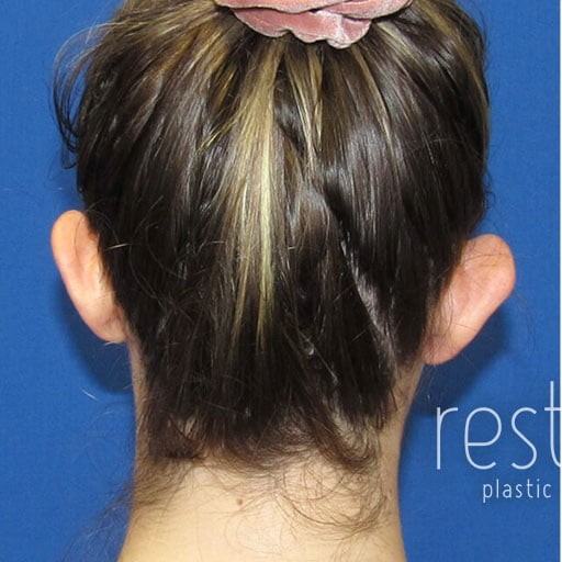 Ear Surgery before and after - before