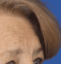 Procedure before and after - after