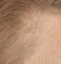 Procedure before and after - before