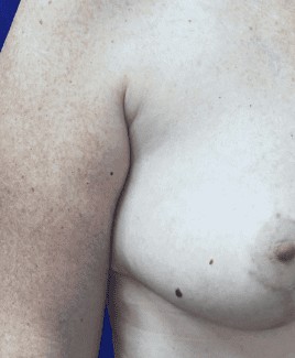 Breast Lift before and after - before
