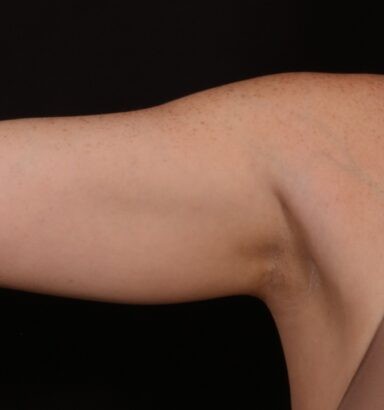 Procedure before and after - after