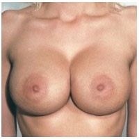 Breast Augmentation before and after - after